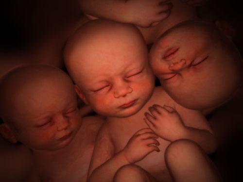 Trillizas idénticas: 1 caso en 200 millones de embarazos se dio en Paraguay